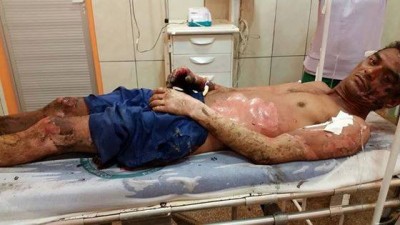 Caminhoneiro que sofreu queimaduras de 3º grau