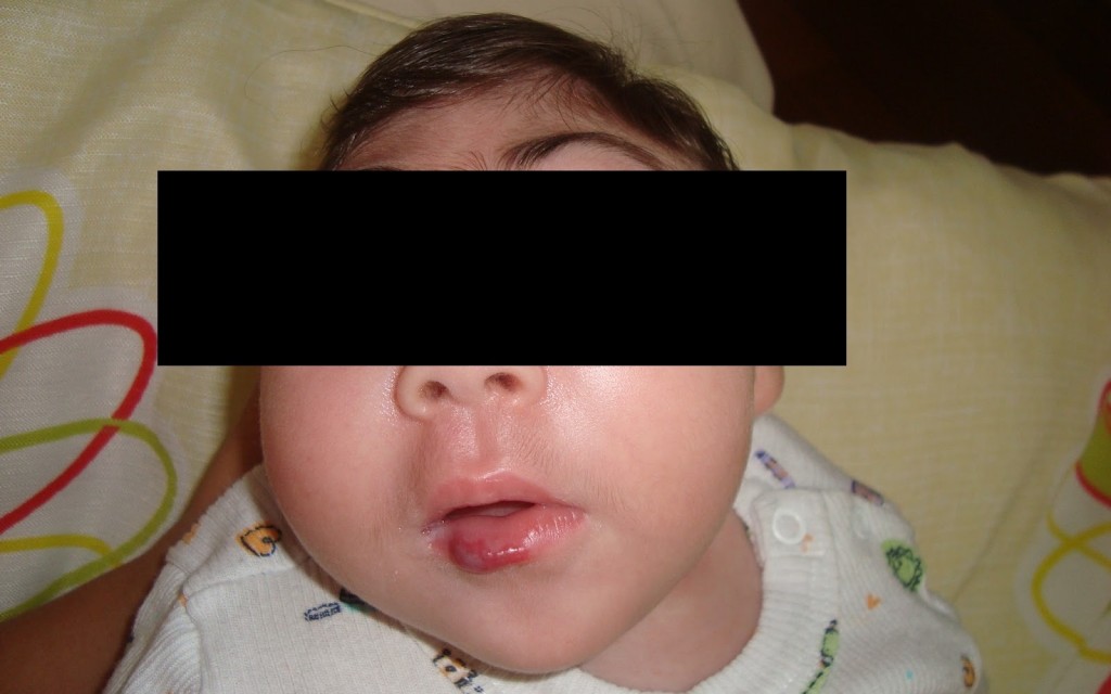 Bebê com microcefalia (foto: internet).